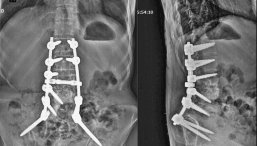 Lumbar Spine Infection Diagnosis in Pune | Mrs. Humbe - The Spine Doctor